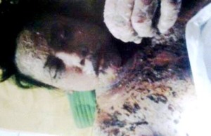 Mal Praktek di RSU Panyabungan Tewaskan Mahasiswi