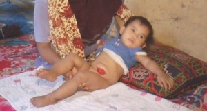 Pemkab Madina Harusnya Biayai Operasi Rizky Wasiah