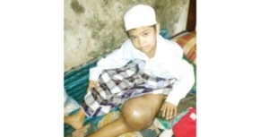 Gerakan Sejuta Santri Didesak Selamatkan Aldi dari Amputasi