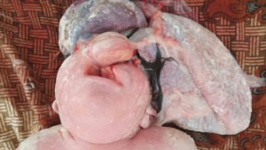 Bayi Lahir Berkelainan Anenchepali